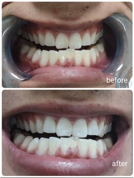 エクシアホワイトニング 沖縄宮里店/お客様ビフォア