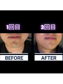 ヤーニング(yearning)/ヒゲ脱毛