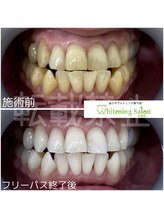 ホワイトニングサロン 札幌店/【ホワイトニング】#札幌#大通り