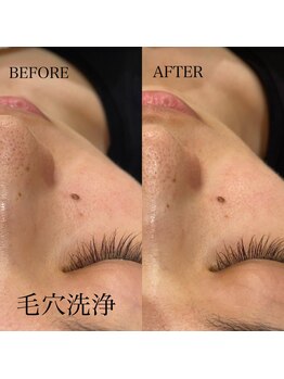 チョコバリ プラス(chocobari plus)/毛穴/黒ずみ/ハイドラ/開き毛穴