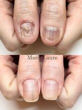 マリーロール 淀屋橋本店(Marie Laure)/自爪育成/深爪矯正/ネイルケア