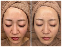 プロット 大阪本店(plot)/LDM・ララピール 施術　