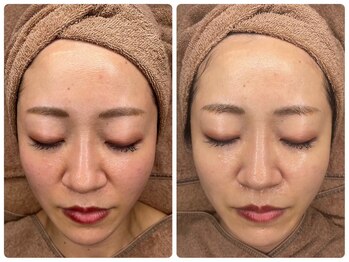 プロット 大阪本店(plot)/LDM・ララピール 施術　