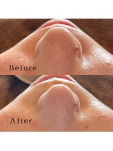 ブリリアントライフ(Blilyant life)/毛穴洗浄＋白玉酸素セラピー