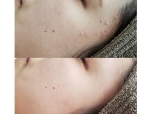 プシュケ(Psyche)/お客様の肌変化