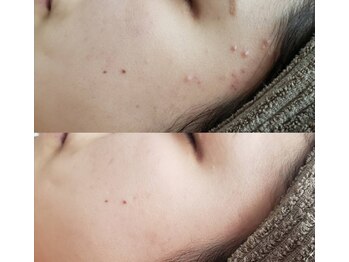 プシュケ(Psyche)/お客様の肌変化