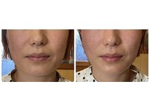 ねこのひげ/エラ張り改善