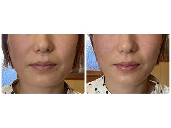 ねこのひげ/エラ張り改善