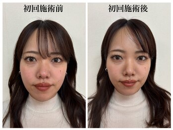 トータルバランス整体院 &nbsp;オレンジ(ORANGE)/小顔矯正/施術前→施術後/改善例