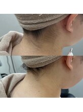 ラクシー 御徒町(luxssy)/うなじシェービング