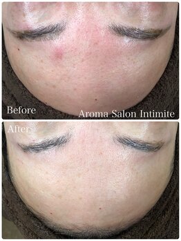 アンティミテ(Intimite)/パーソナルスキンケアコース