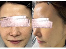 モガナ(mogana)/40代・シミケア半年パスポート