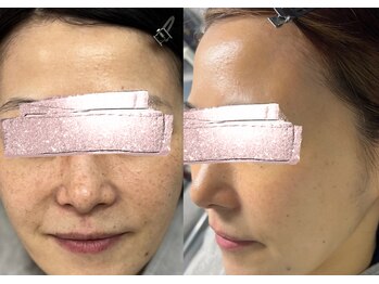 モガナ(mogana)/40代・シミケア半年パスポート