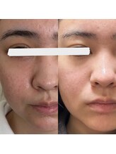 ウイユ(Oeil)/圧倒的棘状美容成分【効果1回】