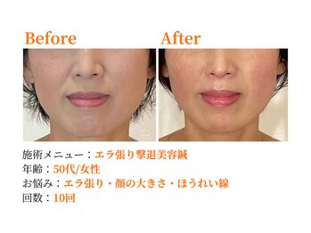 シルエラバレ(CiruelaValle)/Before After