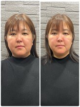 長寿鍼灸院 長寿整骨院/美容鍼50本の効果★小顔効果