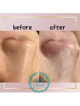 メイト(mate)/毛穴エクストラクションtete式