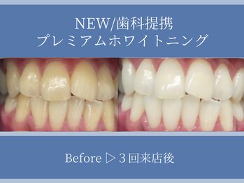 ホワイトニングカフェ 平塚店(WhiteningCafe)/◎歯のホワイトニング施術写真◎
