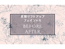 ミラー(MIRAOR)/小顔リフト＆美肌フェイシャル