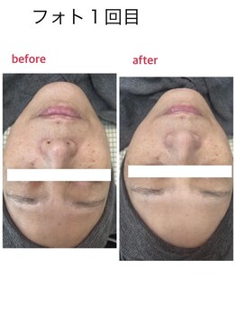 サロンドティアラ(Salon de Tiara)/フォトフラクショナル