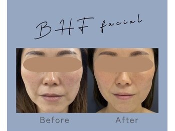 サンカリビューティー(SANKARI beauty)/BHF最新リフトアップ