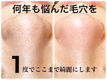 ピエル 北千住店(PIEL)/何年も悩んだ毛穴を綺麗にします