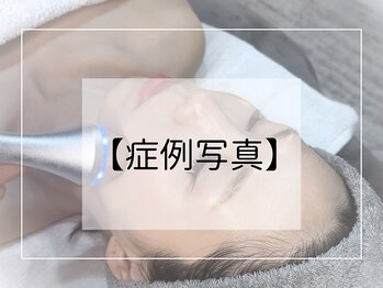 シェステ ゴジュウヨン(shesthe54)/症例写真｜肌質改善