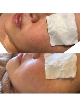 サワコウボウ セラピー(SAWAKOBO therapy)/2bバイオ上ビフォー下アフター