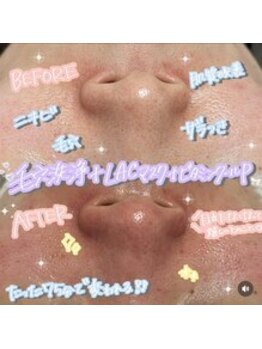 ヴォアール(VOIR)の写真/ハリとツヤUP！ニキビ肌も憧れの肌質改善へ導く、あなただけの特別ケア◎