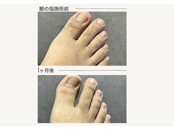 クレビア(CREVIA)/メンズ指先脱毛◆BeforeAfter
