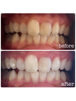 ビューティールームウィズ(beauty room w/)/ホワイトニング！