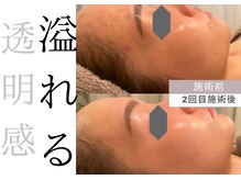 チッチ アフロディーテ(Chicchi Aphrodit)/毛穴洗浄＋ハーブピーリング