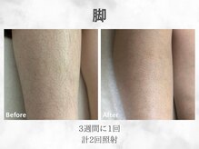 ベル(Belle)/レディース脚脱毛