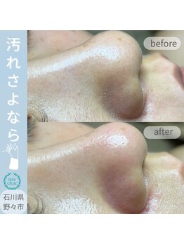 アズール(AZUL)/毛穴エクストラクションtete式◇