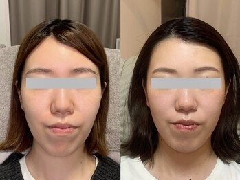 ナビレラ(navillera)/4回の施術フェイスラインの歪み