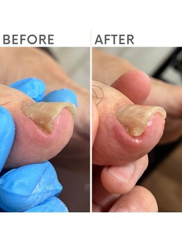 クオッカ(Quokka)/巻き爪ケア