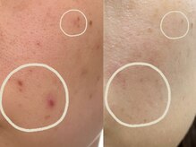 ナガイ美容/カーボンフェイシャル施術例