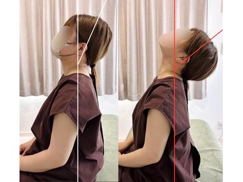 フラット(flat)/ビフォーアフター/首肩の施術