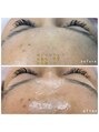ヴィーナス(Venus) フェイシャルWax