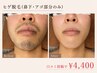 【男性口コミ限定】ヒゲ脱毛 ￥4,400