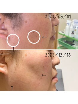 アルディート(Ardito)/ホワイトスノーピール