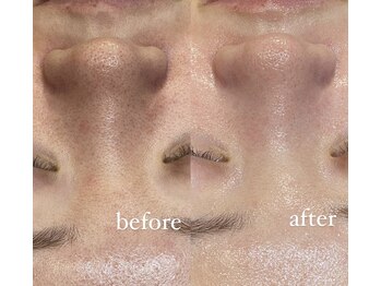 レシェルサロン(Lechelle Salon)/黒ずみ毛穴/皮脂つまり毛穴