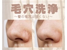 アルゴ 熊本光の森店(ALGO)/【毛穴】毛穴ごっそり大洗浄！