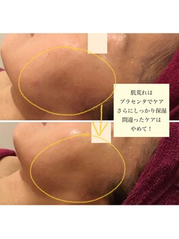 グレッセン(glanzen)/肌荒れはホームケアも大切