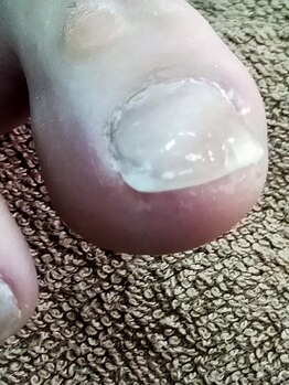 越谷ゆずりは整体院/巻き爪補正