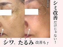 ソイ(Soi)/シミ改善だけじゃない！