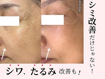 ソイ(Soi)/シミ改善だけじゃない！