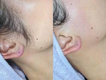 ムーン 横浜(MOON)/【もみあげ】