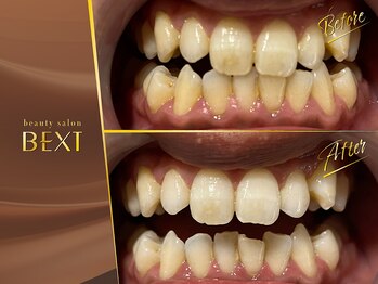 ベクスト(BEXT)/セルフホワイトニング