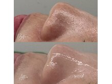 アピール(Appeal)の雰囲気（黒ずみ毛穴をクリアに導く、始めるならＷＡＸケアから）